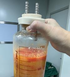 玉田水动力吸脂手术要做多久？